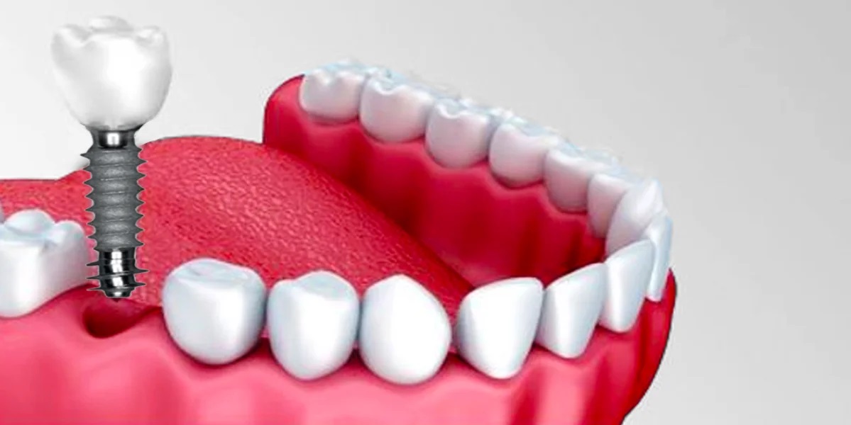 Dentist Supports